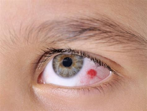Popped Blood Vessel in Eye .